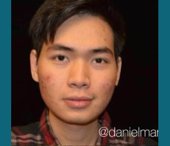 MORPHEUS8 RADIO FREQUENCY MICRONEEDLING before