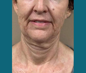 MORPHEUS8 RADIO FREQUENCY MICRONEEDLING before