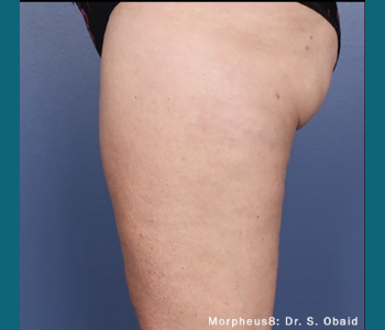 MORPHEUS8 RADIO FREQUENCY MICRONEEDLING after