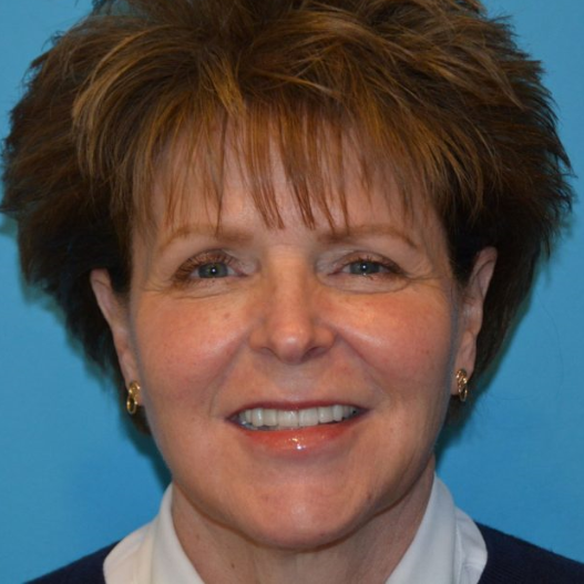 Botox Cosmetic after Treatment