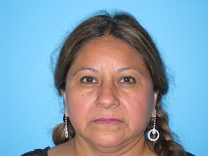 BEAUTIFY-LIFE LIFT GALLERY Before