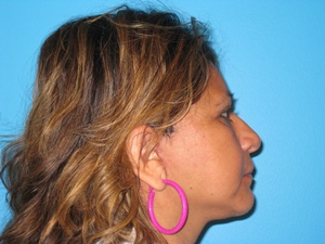 BEAUTIFY-LIFE LIFT GALLERY AFTER