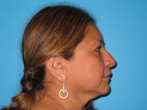 BEAUTIFY-LIFE LIFT GALLERY Before