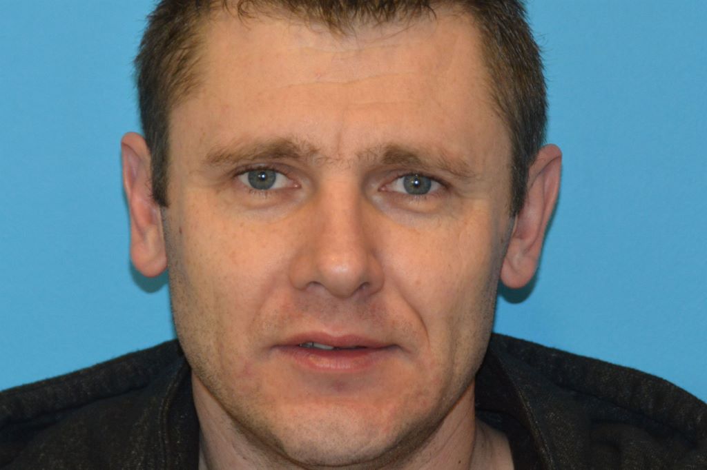 CHEEK IMPLANTS GALLERY AFTER