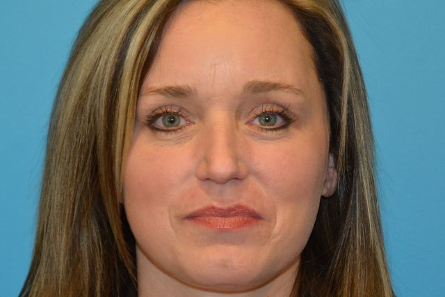 LASER RESURFACING After