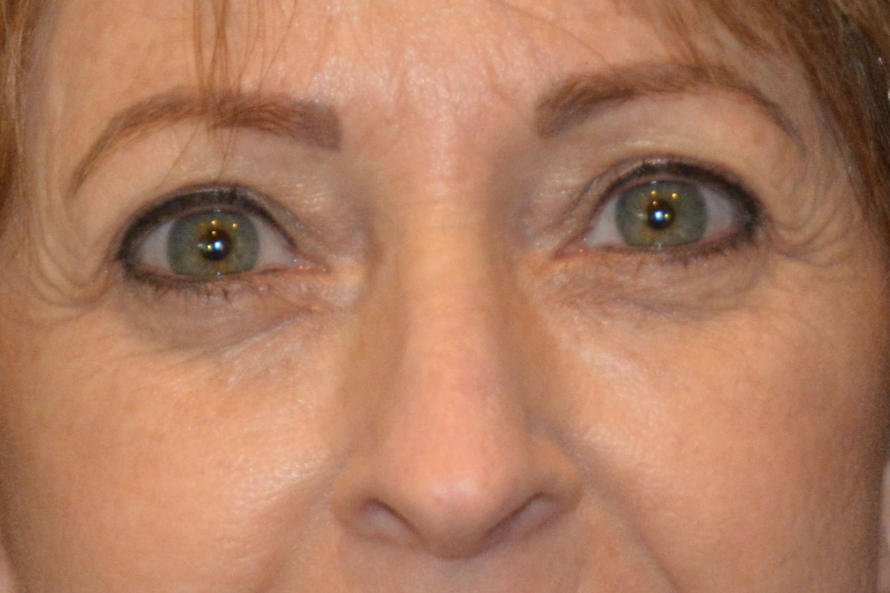 EYELID SURGERY GALLERY After