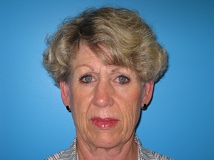 BEAUTIFY-LIFE LIFT GALLERY Before