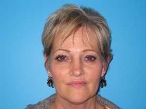 MINI FACELIFTS Before