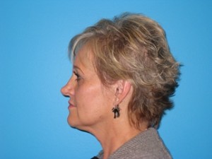 MINI FACELIFTS Before