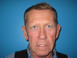 BEAUTIFY-LIFE LIFT GALLERY Before