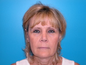 BEAUTIFY-LIFE LIFT GALLERY Before