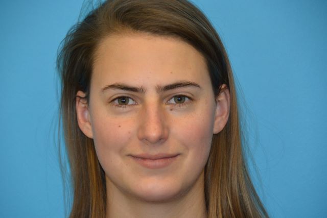 CHIN IMPLANTS GALLERY in west jordan Utah