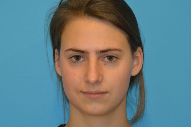 CHIN IMPLANTS GALLERY BEFORE