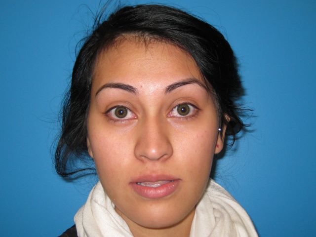 JAW SURGERY GALLERY Before