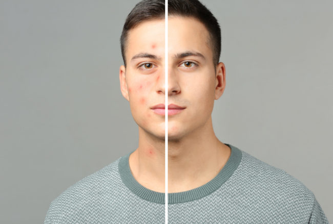 Acne | Utah Facial Surgical Arts