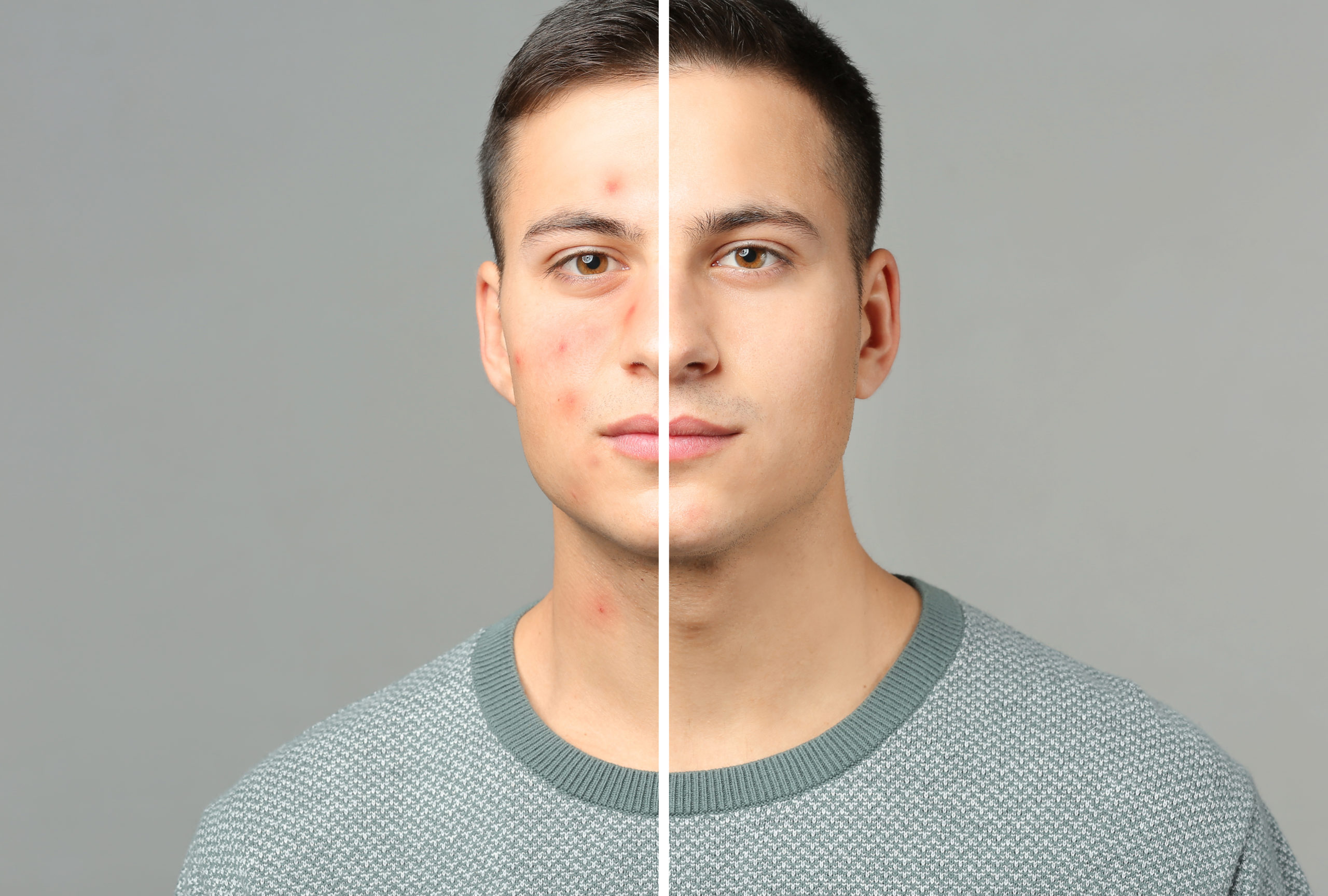Acne | Utah Facial Surgical Arts
