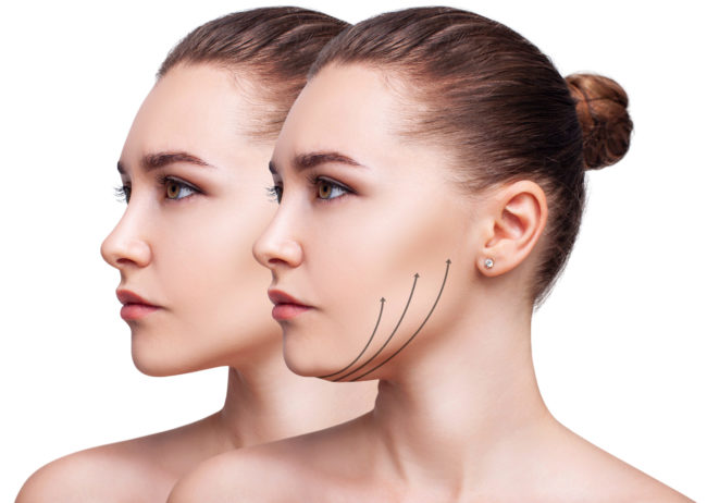 What Type Of Mini Face Lift Can Be Done To Raise Cheekbone What Type Of Mini Face Lift Can Be Done To Raise Cheekbone
