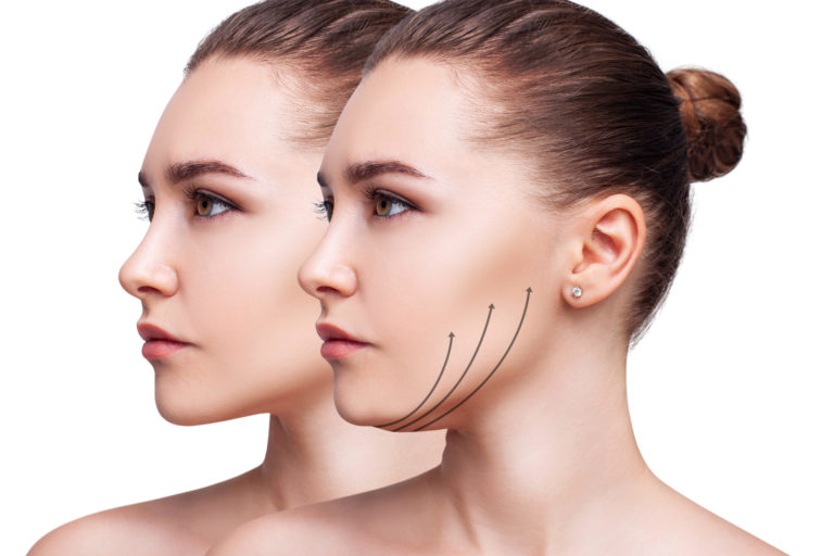 What Type Of Mini Face Lift Can Be Done To Raise Cheekbone
